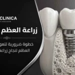 زراعة العظم للاسنان خطوة ضرورية لتعويض فقدان العظم لنجاح زراعة الأسنان