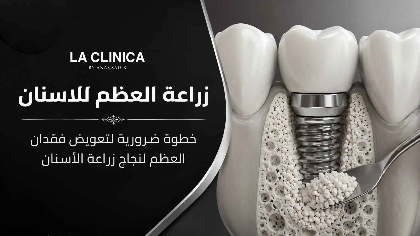 زراعة العظم للاسنان