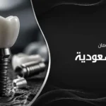 سعر زراعة سترومان في السعودية وأهم العوامل المؤثرة