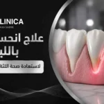 علاج انحسار اللثة بالليزر لاستعادة صحة اللثة وحماية الأسنان
