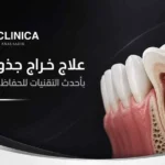 علاج خراج جذور الاسنان بأحدث التقنيات للحفاظ على صحة الفم