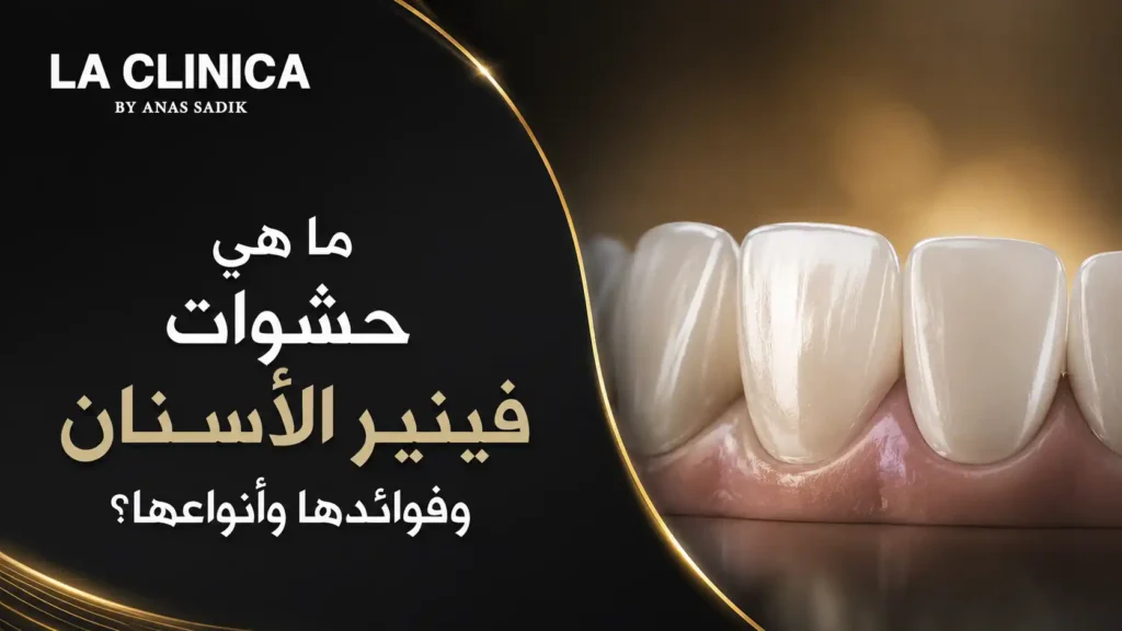 ما هي حشوات فينير الأسنان وفوائدها وأنواعها؟