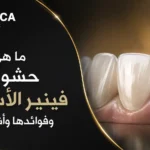 ما هي حشوات فينير الأسنان وفوائدها وأنواعها؟