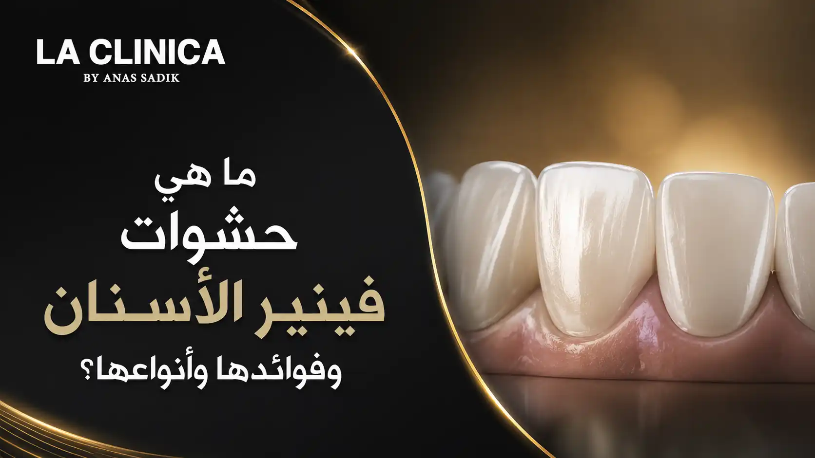 ما هي حشوات فينير الأسنان وفوائدها وأنواعها؟