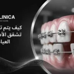 ماهي مدة تقويم الاسنان لسد الفراغات وأهم العوامل المؤثرة؟