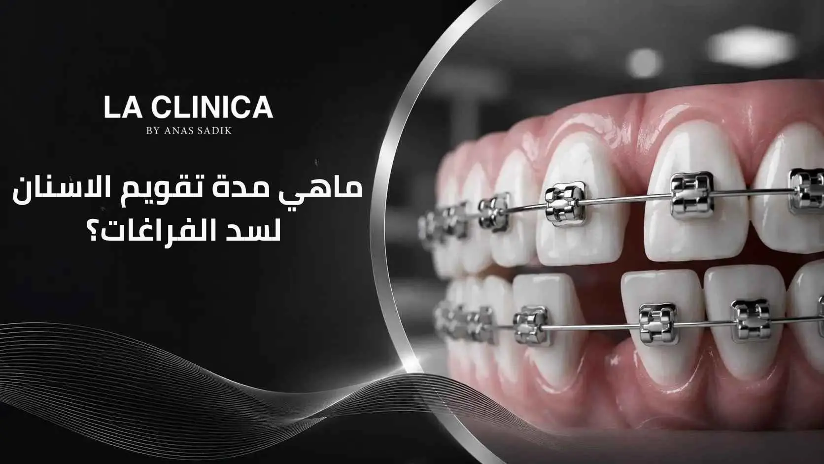 ماهي مدة تقويم الاسنان لسد الفراغات وأهم العوامل المؤثرة؟