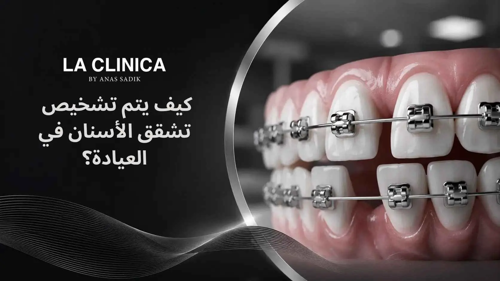 ماهي مدة تقويم الاسنان لسد الفراغات وأهم العوامل المؤثرة؟