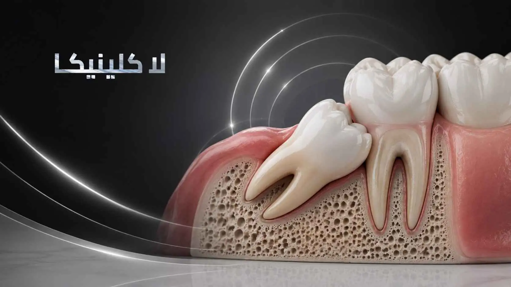 اعراض ضرس العقل المدفون السفلي اعراض ضرس العقل المدفون السفلي
