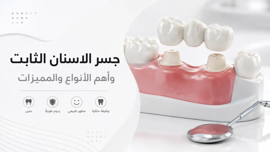 جسر الاسنان الثابت
