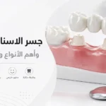 جسر الاسنان الثابت وأهم الأنواع والمميزات