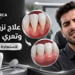 علاج نزول اللثة وتعري الأسنان لاستعادة صحة اللثة