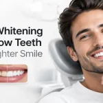 Teeth Whitening for Yellow Teeth for a Brighter Smile